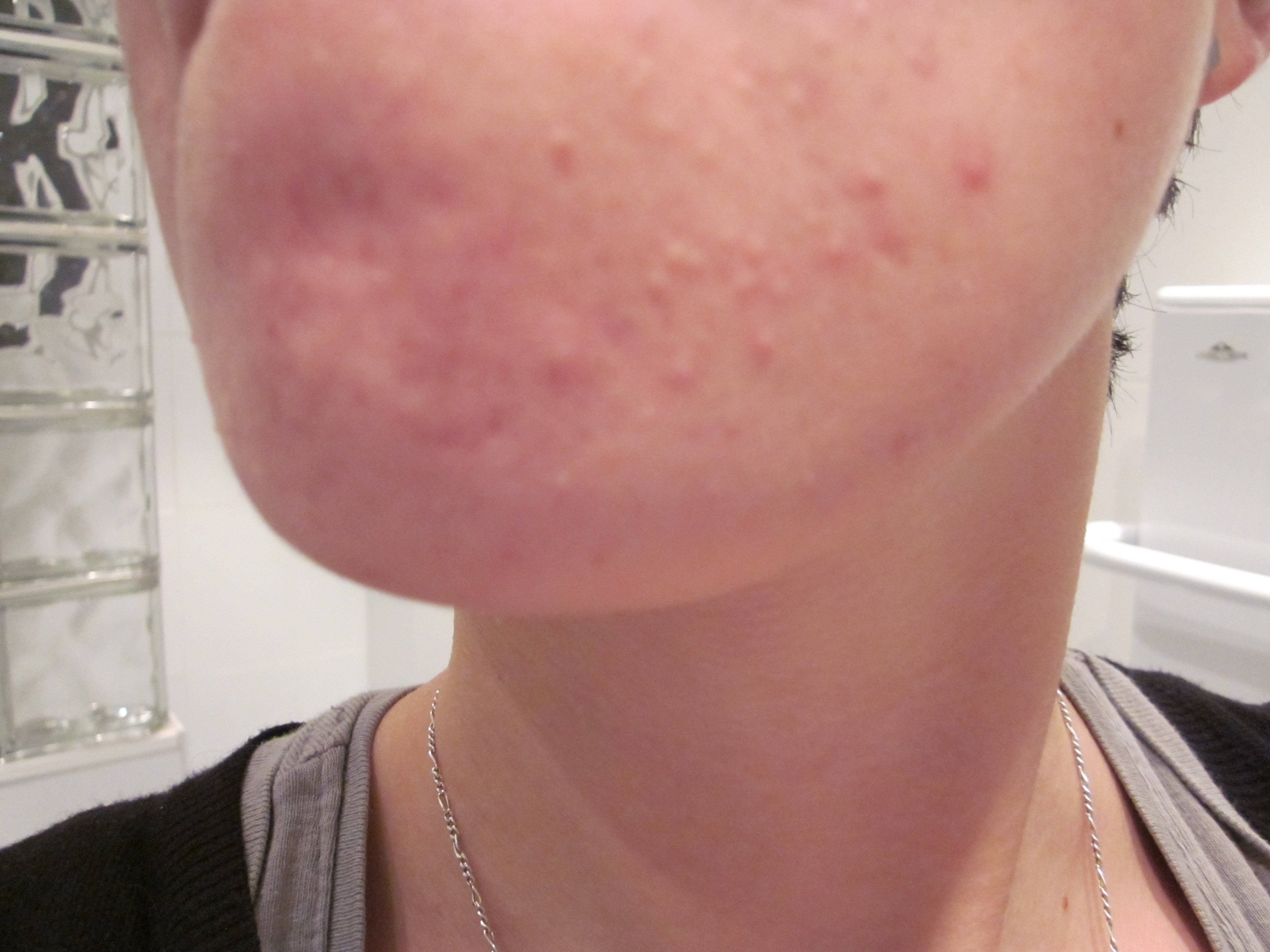microkyste blanc visage microkyste blanc visage